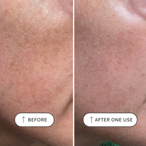 Sensitive Resurfacing Peel